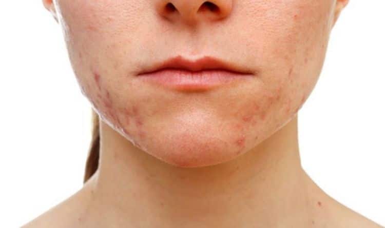 hormonal acne natural treatment