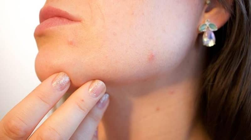 The Must-Know Tips For A Successful Cure for Hormonal Acne On The Chin